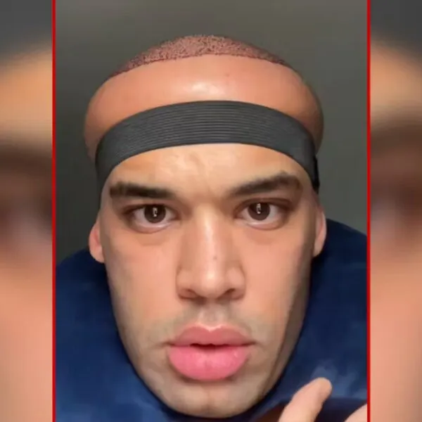 Schock nach Haartransplantation: Influencer sieht aus wie ein Alien – „Mein Kopf ist ein Ballon!“