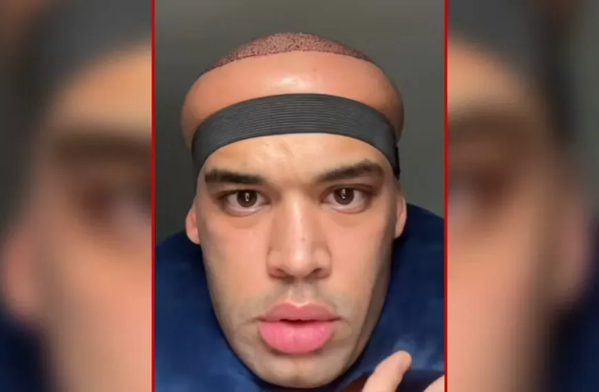 Schock nach Haartransplantation: Influencer sieht aus wie ein Alien &ndash; &bdquo;Mein Kopf ist ein Ballon!&ldquo;
