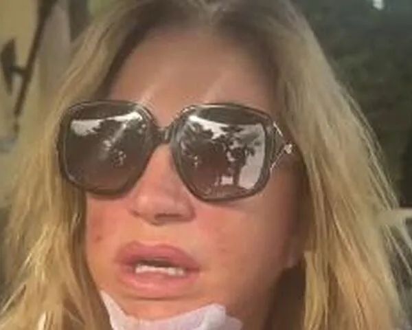 So geht es Carmen Geiss nach der Hirn-OP