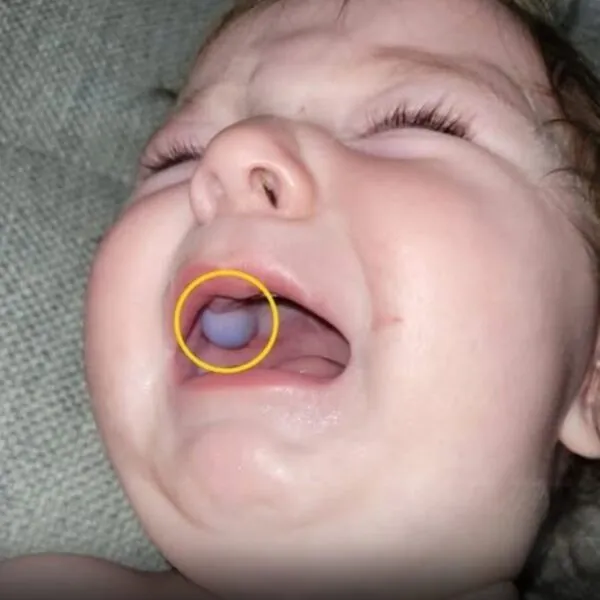 &Auml;rzte dachten, dass das Baby einen Tumor im Mund h&auml;tte &ndash; aber die Wahrheit lie&szlig; alle sprachlos